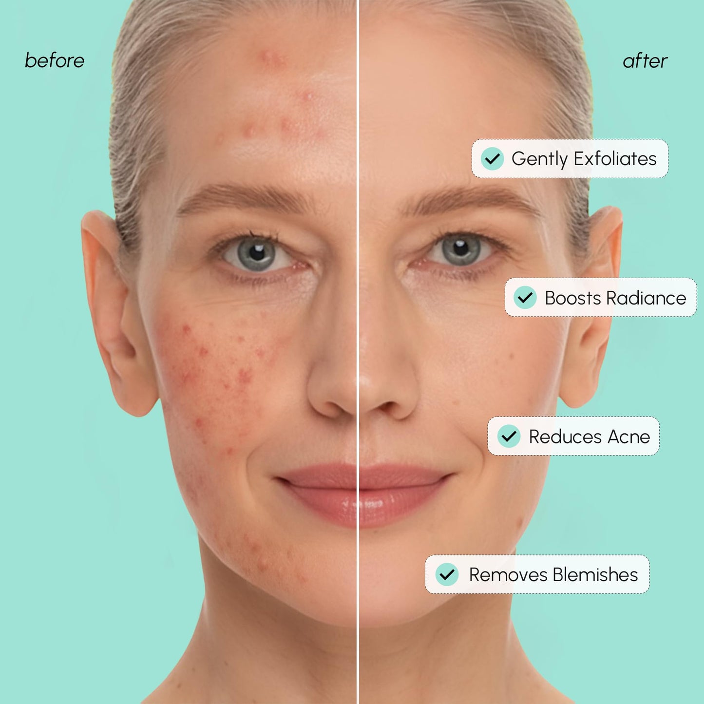 MAREE Azelaic Acid Acne Clearing Pads – Exfoliating Pads with Glycolic & Hyaluronic Acid for Face – 10% Azalecic Acid & Centella Redness Soothing Pad – Zero Pore Facial Toner Pad – Acido Azelaico