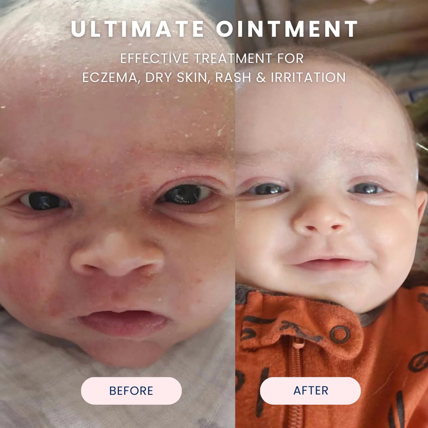 Noodle & Boo Ultimate Baby Ointment for Eczema and Diaper Rash Healing, 3.4 Oz