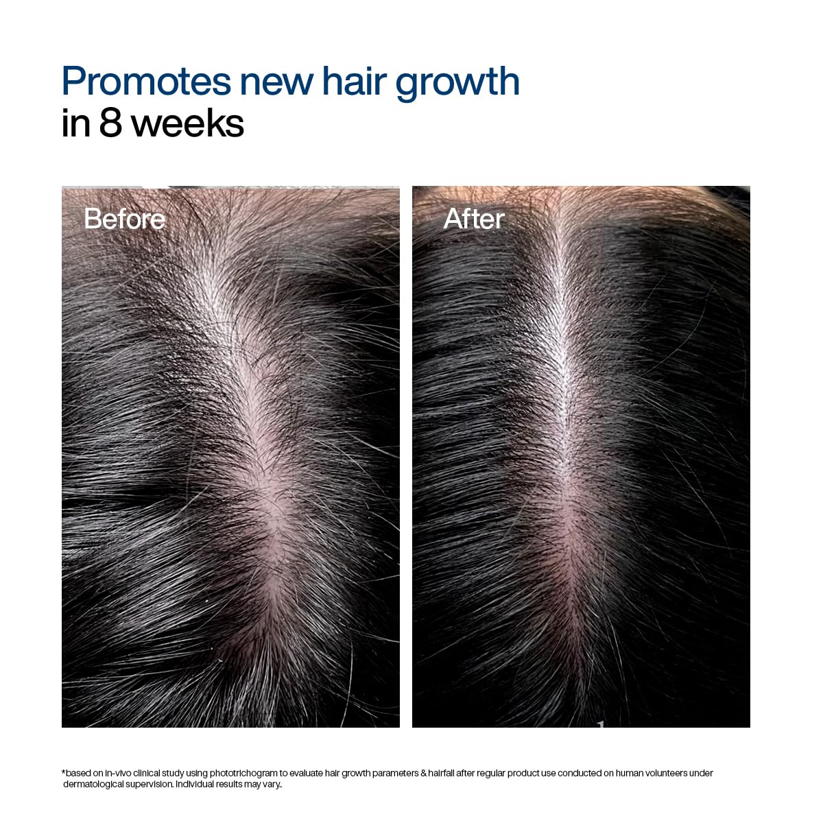 WishCare Hair Growth Serum Concentrate - Rosemary, 3% Redensyl, 4% Anagain, 2% Baicapil, Caffeine, Biotin, Plant Keratin & Rice Water