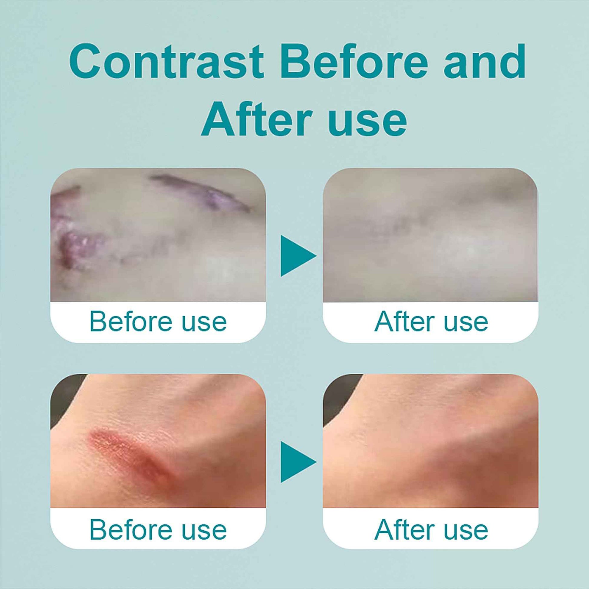 Silicone Scar Gel 20g, Effective Scar Cream - Reduces The Appearance of Both Old and New Scars from Burns, Injury, Acne, Stretch Marks, Keloid, C-Section