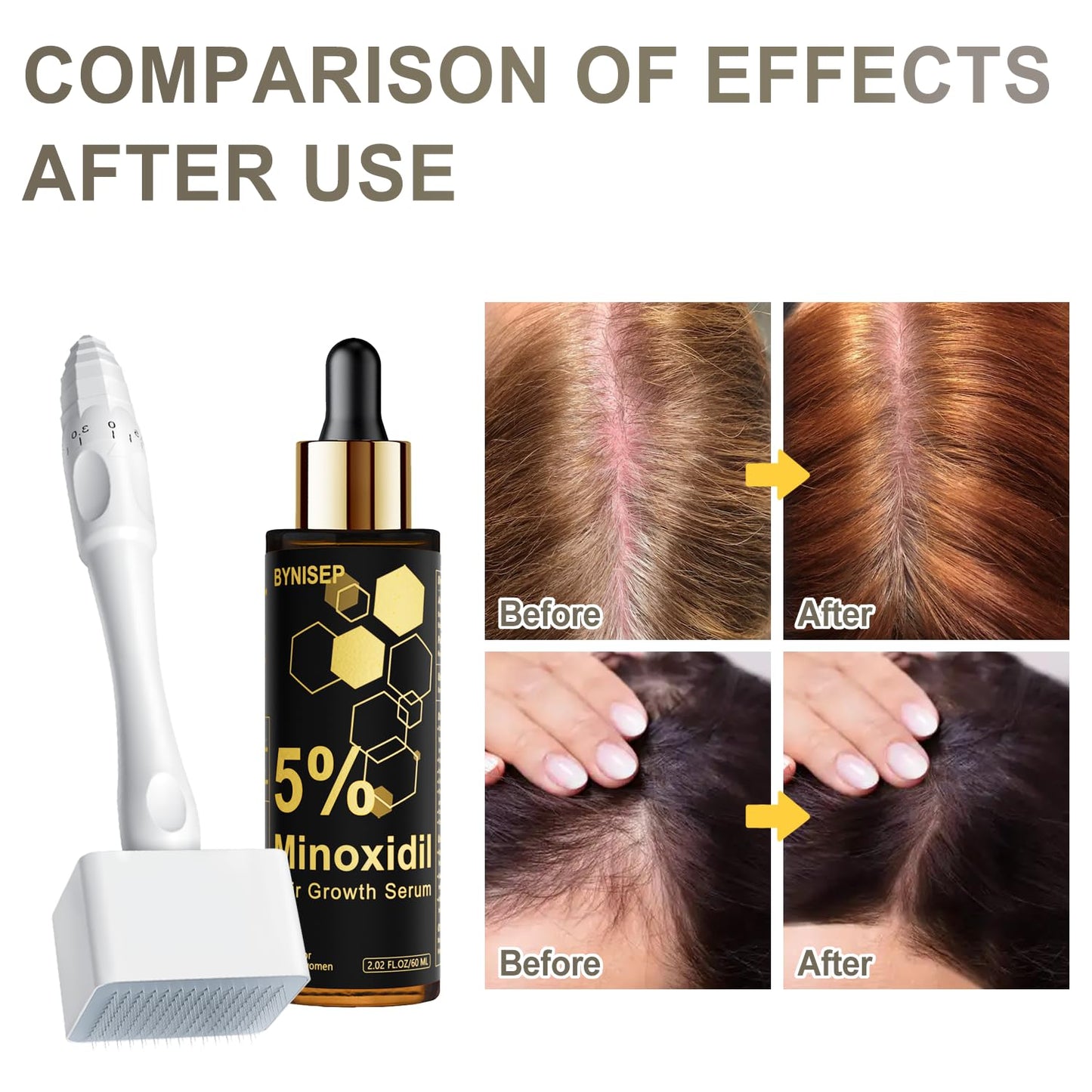 5% Minoxidil Beard Growth Serum for Men and Women, for Hair and Beard Regrowth Treatment - 60ml