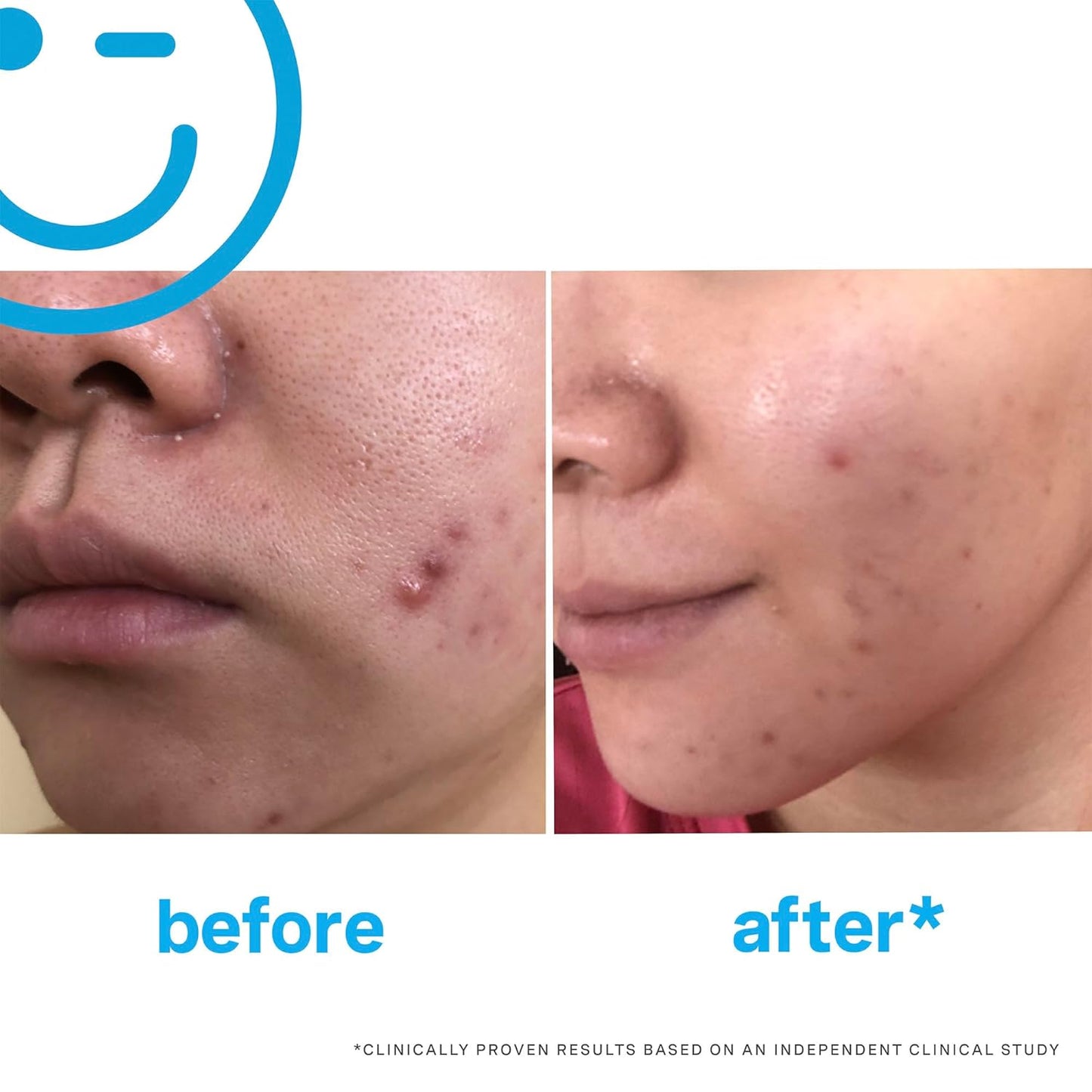 Kate Somerville Acne Treatment Set | EradiKate 3% Sulfur Cleanser & Mega-A Anti-Aging Serum | 4 oz & 1 oz
