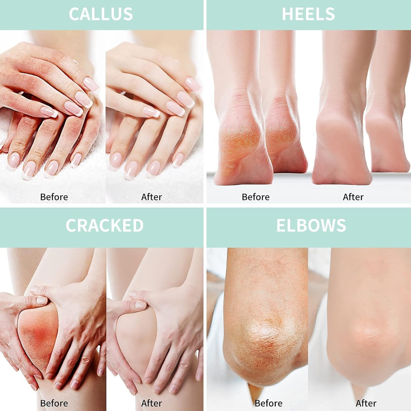 Urea Cream 50 Percent for Feet with Coconut 5.29 oz || Foot & Hand Cream Maximum Strength with 2% Salicylic Acid, Tea Tree and Aloe Vera for Deep Moisturizing and Callus Removing (Classic Formula)