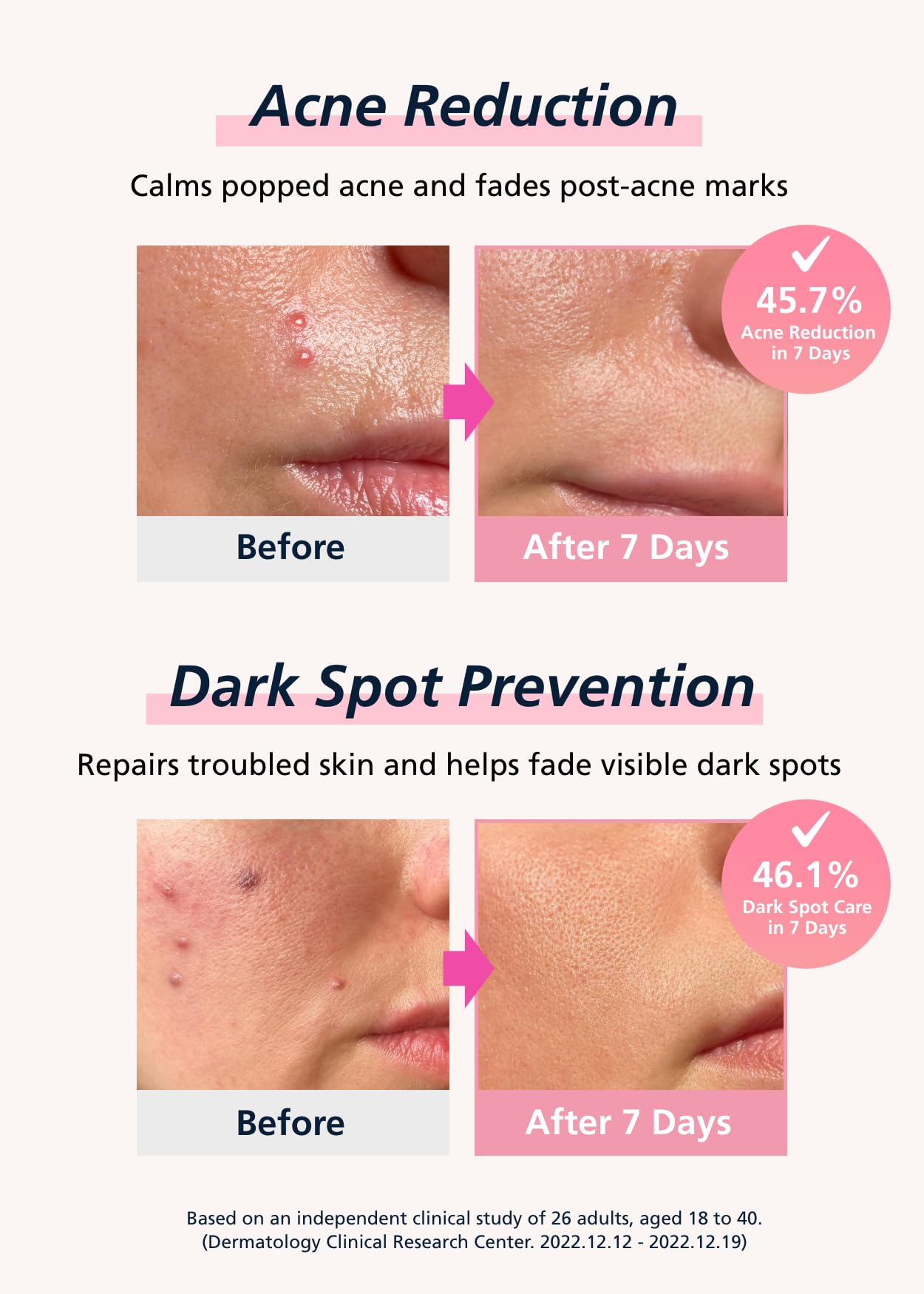 Easyderm Real Calming Patch Pimple Patches, Niacinamide, Hyaluronic Acid, EGF, K-Beauty Skincare | 6 Patches per Pack, 4 Packs (24 Total) Micro Point length : 285μm Summer & Travel Essentials