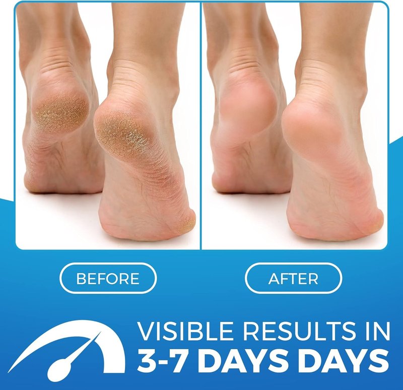 2 in 1 Foot Cream for Dry Cracked Heels - XL Foot Repair Cream for Dry Feet - Suitable for Diabetics - Used by Professionals