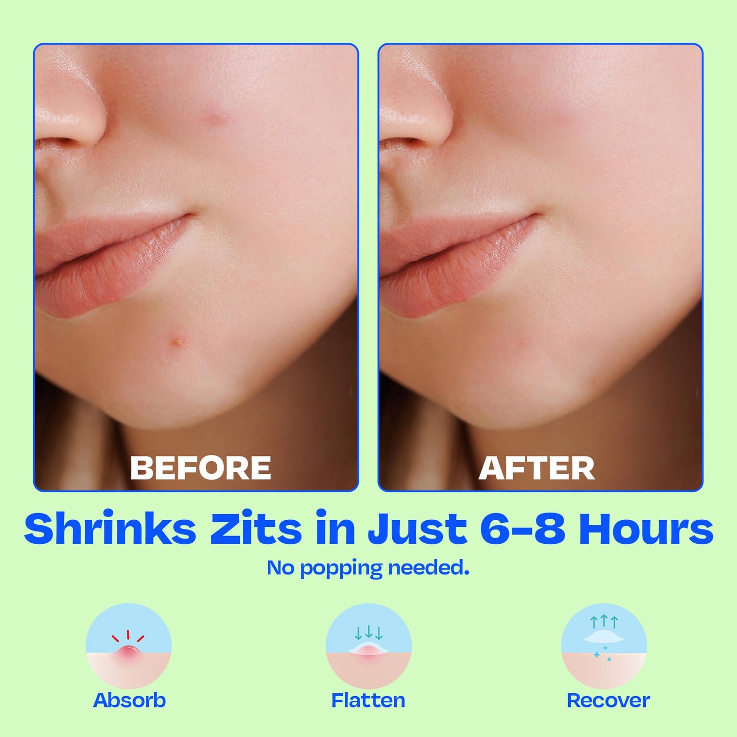 JB SKRUB Pimple Patches for Kids, Teens & Boys‚ 3 Pack of 75 Hydrocolloid Patches with Salicylic Acid & Niacinamide‚ Multiple Sizes
