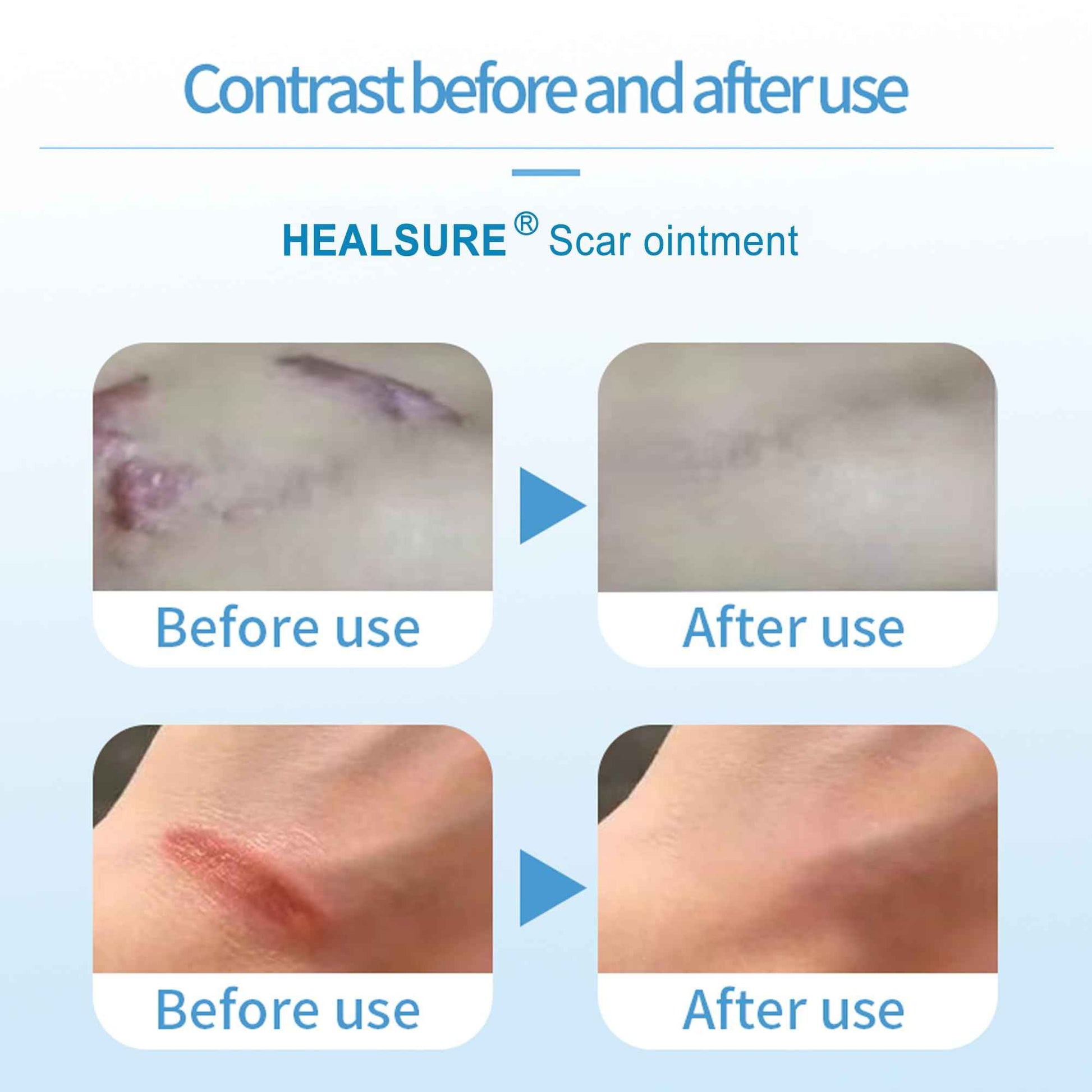 Silicone Scar Gel, Scar Cream for Acne Scars, C-Section, Hypertrophic & Dark Scars, Fade Scars & Improve Skin