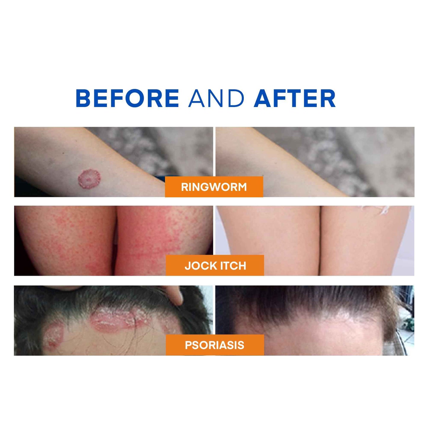 Hermon Powerful Ringworm Antifungal Soap – Treatment for Ringworm, Athlete’s Foot & Jock Itch – Tea Tree Oil & Sulfur Formula – Fungal Soap for Daily Body Wash – 2 Pack