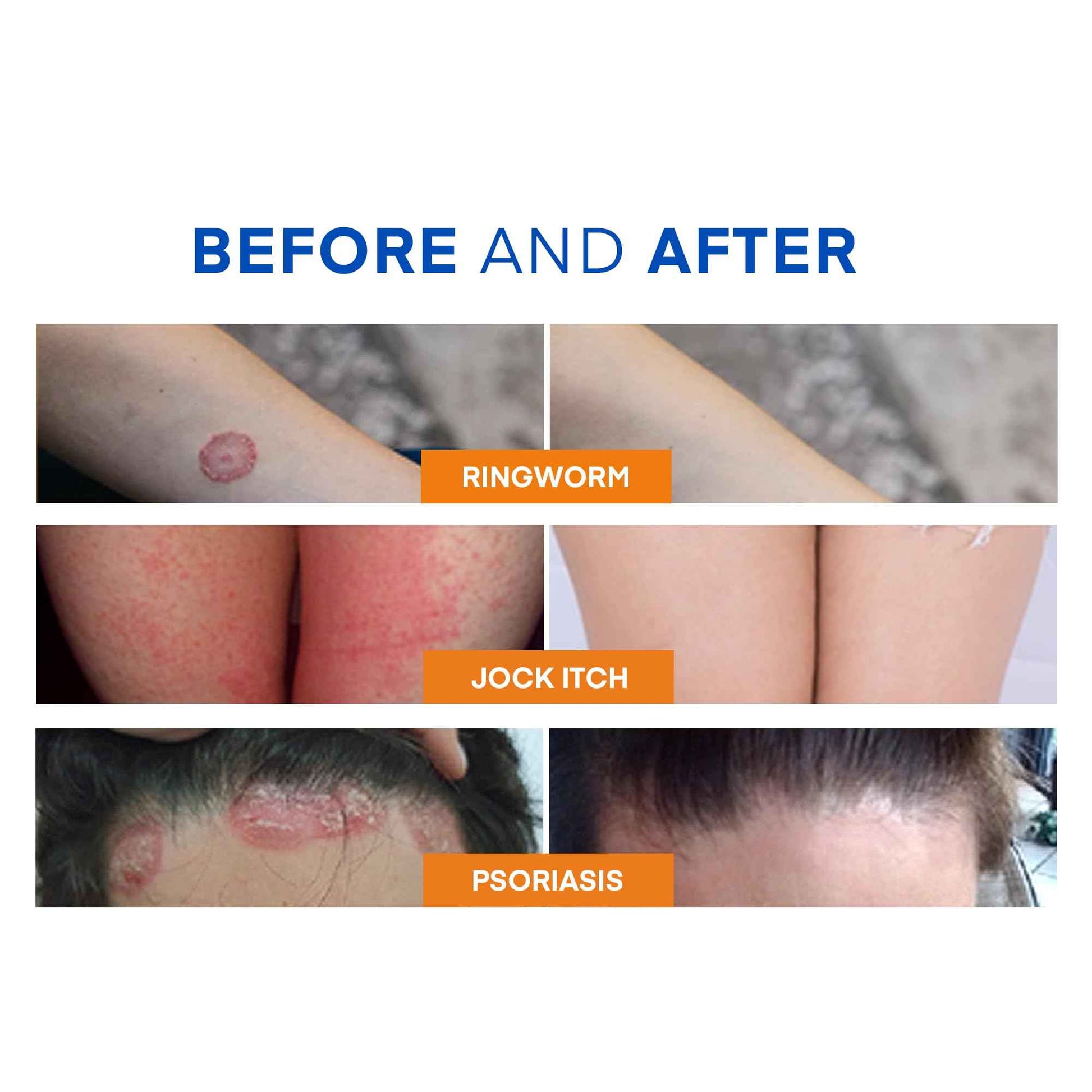 Hermon Powerful Ringworm Antifungal Soap – Treatment for Ringworm, Athlete’s Foot & Jock Itch – Tea Tree Oil & Sulfur Formula – Fungal Soap for Daily Body Wash – 2 Pack