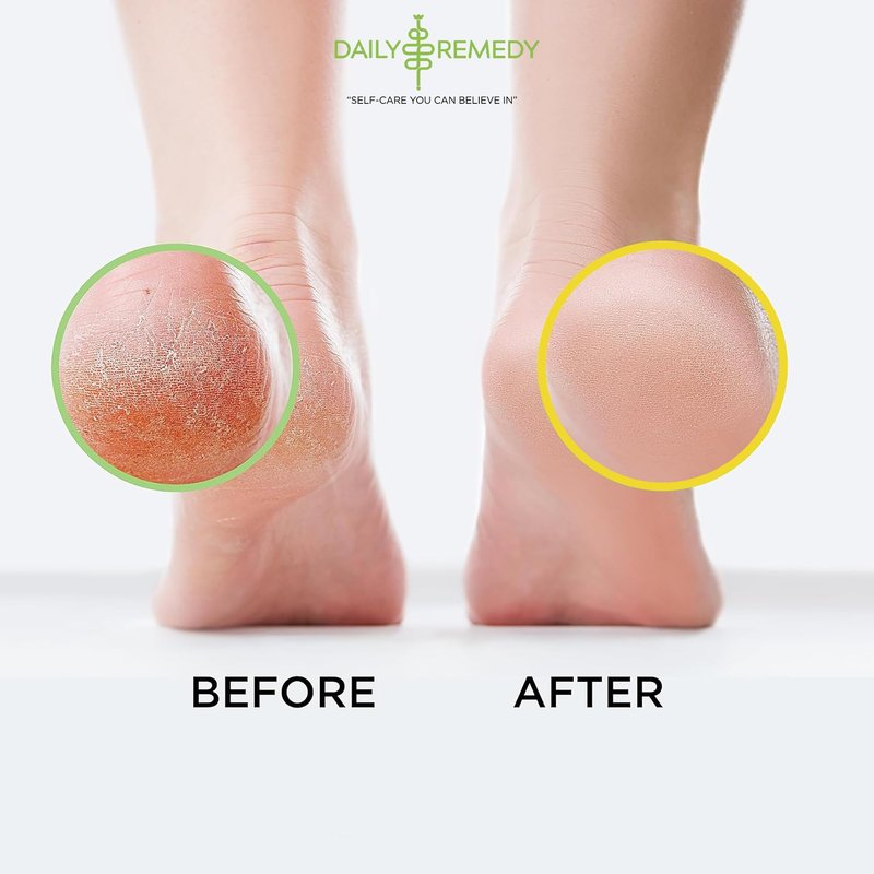 DAILY REMEDY EXTRA STRENGTH Tea Tree Oil & Citrus Detox Foot Soak Set - Made in USA - Soothes Sore Tired Feet, Athletes Foot, Stubborn Foot Odor, Softens Calluses & Refreshes & Detoxifies - Pack of 2