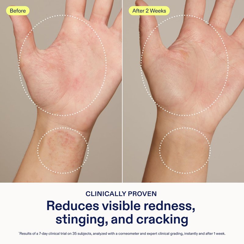 Skinfix Hand Relief Cream - 3 fl oz - Reduces Visible Redness, Stinging & Cracking for Dry, Sensitive Skin - Accepted by the National Eczema Association - Fragrance Free - Vegan, Cruelty Free