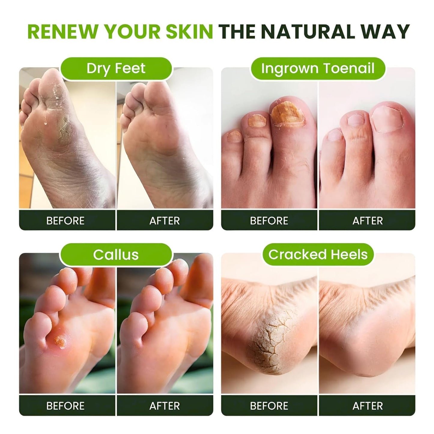 Tea Tree Oil Foot Soak with Epsom Salts - Relieve Pain, Soreness, Fungal Issues | Pack of 4