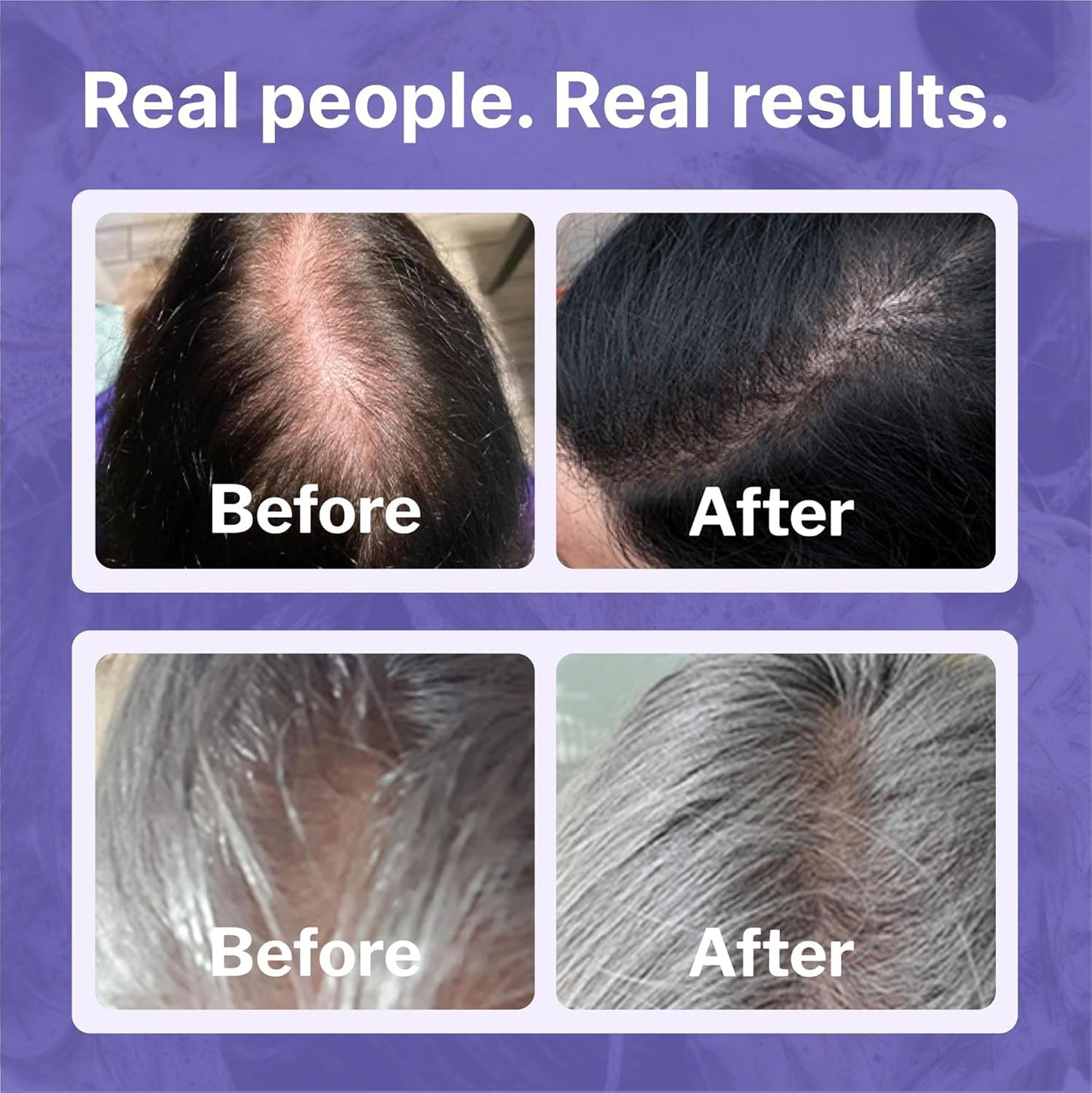 Shapiro MD Hair Growth Experts Womens Hair Regrowth Travel Kit: Leave-In Foamer, 2% Minoxidil. Experience Healthier, Fuller and Thicker looking Hair