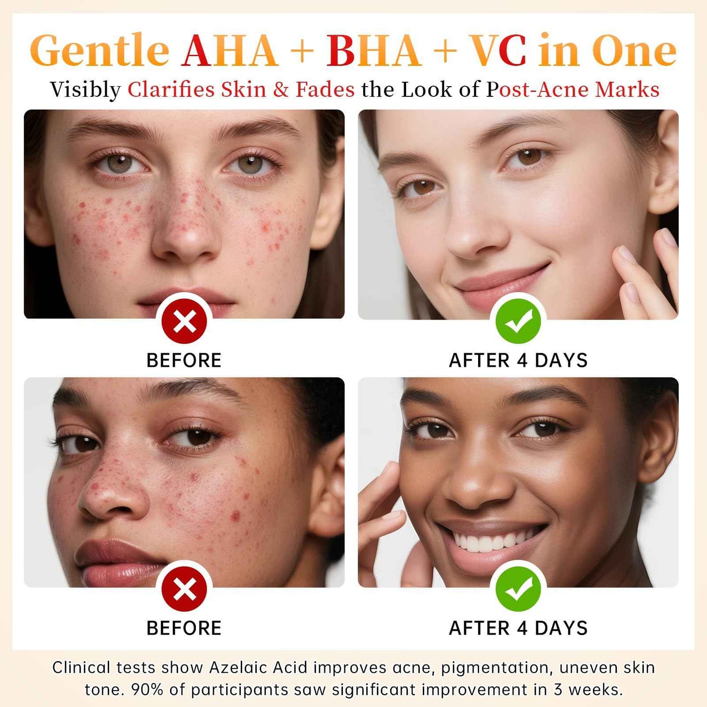 14% Azelaic Acid Acne Cream - Dark Spot Remover for Face, Acne Treatment & Spot Care Salicylic Acid & Niacinamide – Redness Reducing Skin Care, Evens Tone & Soothes Irritation, Rosacea - 2 Pcs.1oz