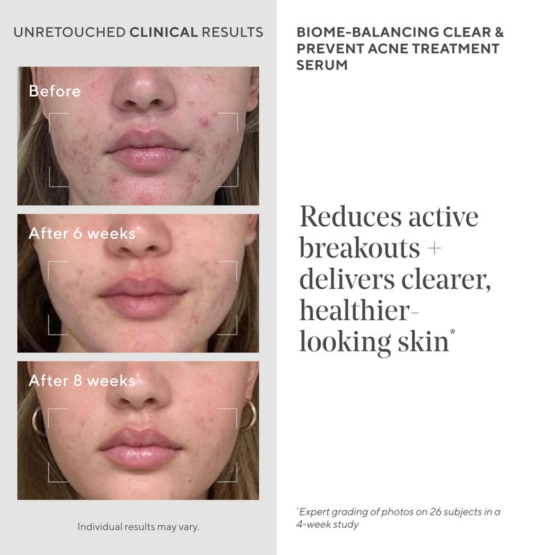Acne Treatment Trial Kit – Salicylic Acid & Mandelic Acid for Clear Skin – Oil Control, Spot Treatment & Cleanser – Travel Size Skincare for Acne-Prone Skin (3-Piece Clear Skin Kit)