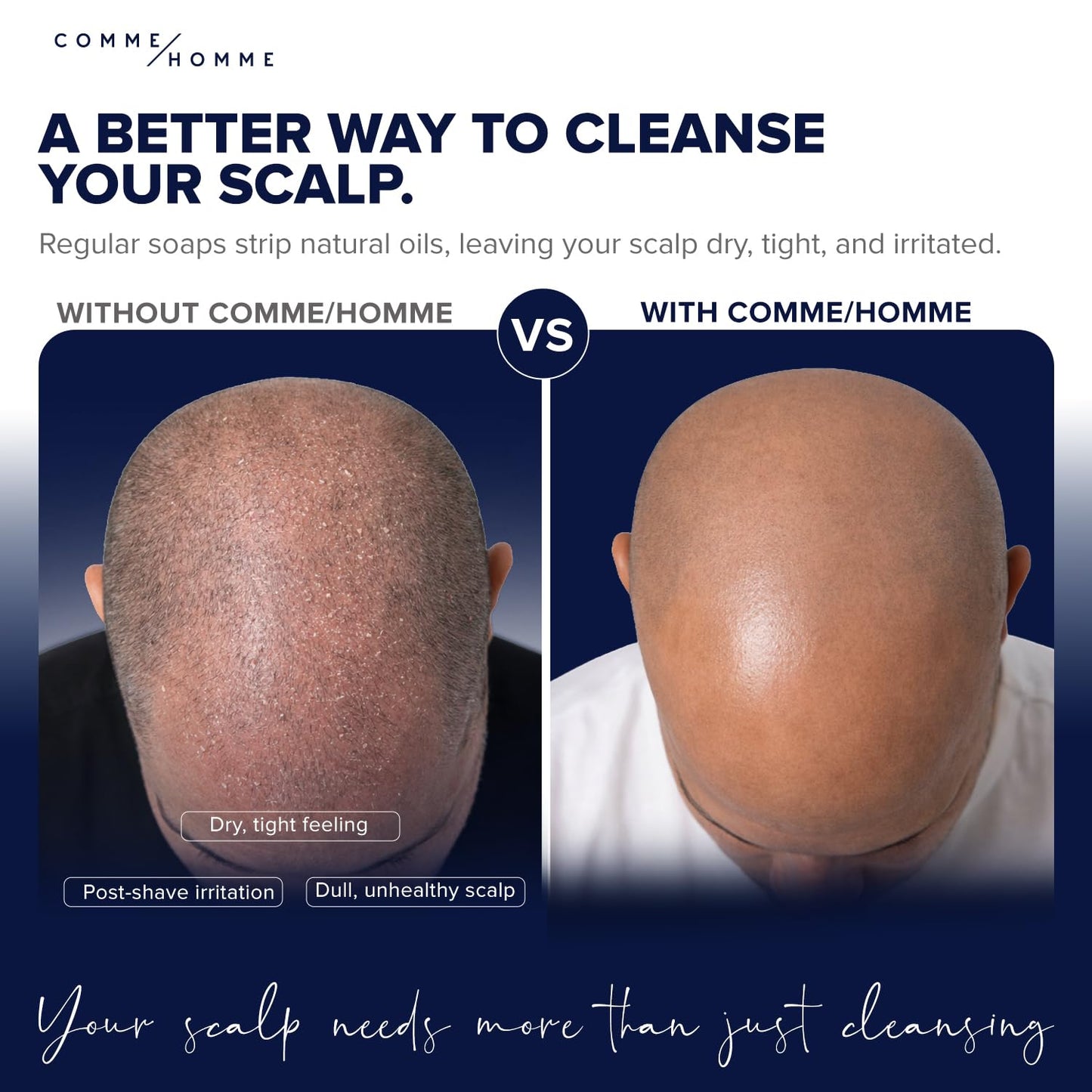 **Hydrating Scalp Wash for Bald Men - Gently Cleanses & Soothes with Basil, Aloe & Caffeine | 5 fl. oz / 150 ml**