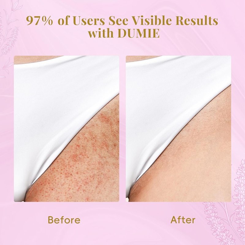 Cyperus Rotundus Serum Roll-On | Ingrown Hair & Razor Bump Treatment, Natural Growth Inhibitor for Sensitive Skin