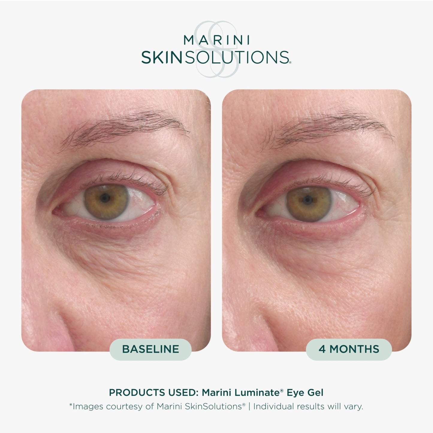 Marini SkinSolutions Luminate Eye Gel - Reduces Appearance of Dark Circles, Crepey Skin, Fine Lines & Wrinkles with Retinol, Chromabright & Peptides - Cruelty Free - Made in the USA - 0.5 fl oz