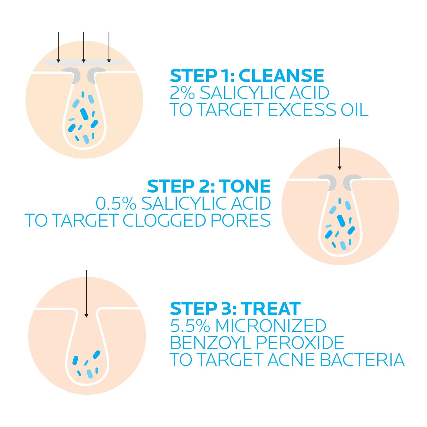 La Roche-Posay Effaclar Dermatological 3 Step Acne Treatment System, Salicylic Acid Acne Cleanser, Pore Refining Toner, and Benzoyl Peroxide Spot Treatment for Sensitive Skin