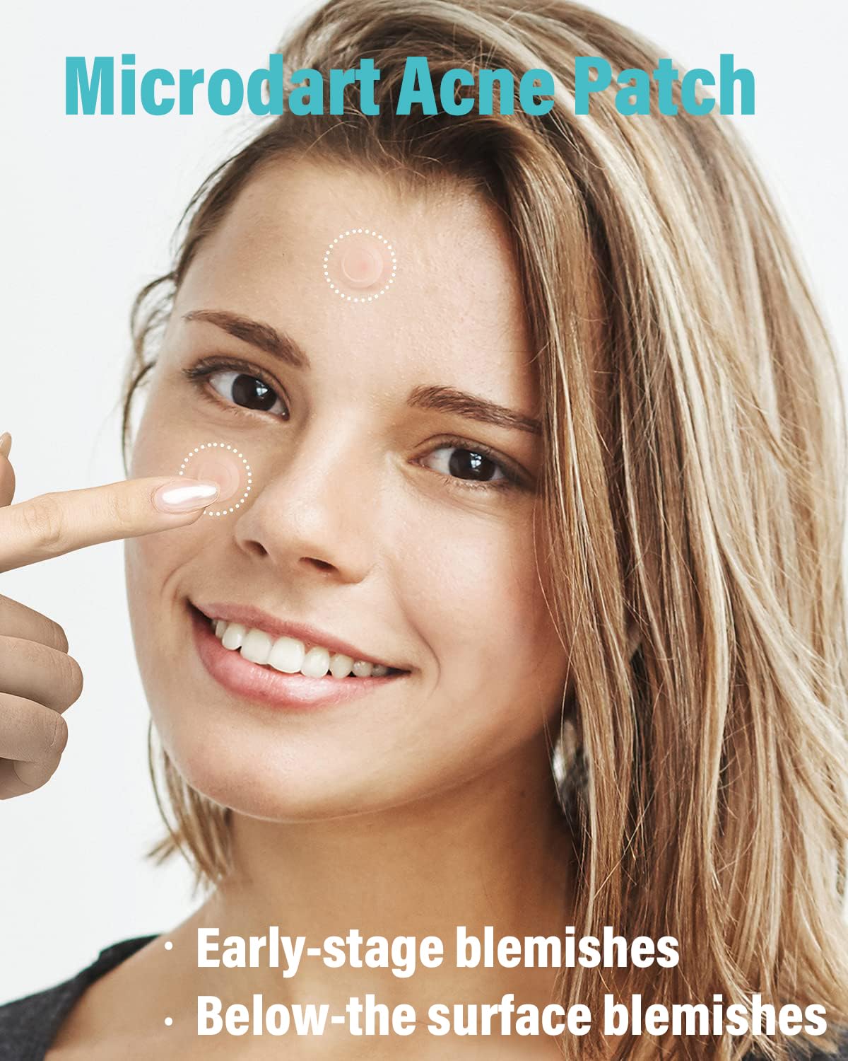 Microdart Acne Patch - Hyaluronate & Salicylic Acid Hydrocolloid Treatment for Deep Blemishes | 72 Patches