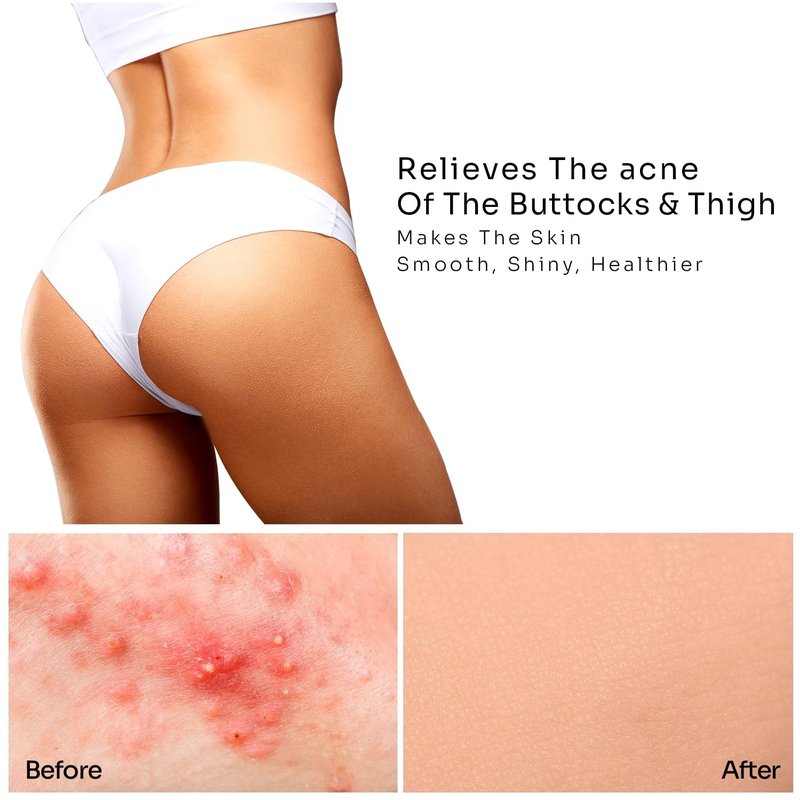 Butt & Thigh Acne Treatment - Fights Acne, Pimples, Zits, Blackheads and Ingrown Hairs for the Buttocks and Thigh Area. Fades Away Dark Spots, Acne marks. Prevents Future Breakouts. 6.09 oz