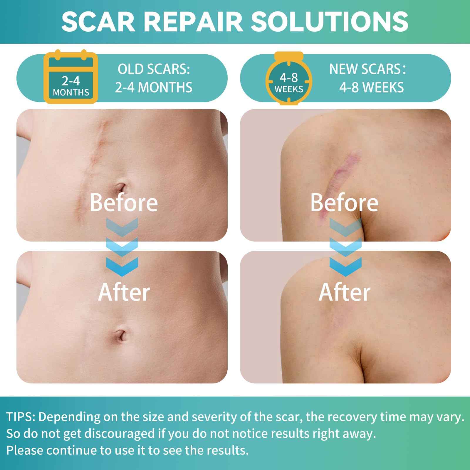 Silicone Scar Tape, Silicone Scar Sheets(1.6"X 120" Roll-3M), Reusable Medical Grade Silicone Tape for Scars, C-Section, Keloid, Acne, Tummy Tuck, Surgical Scars, Light