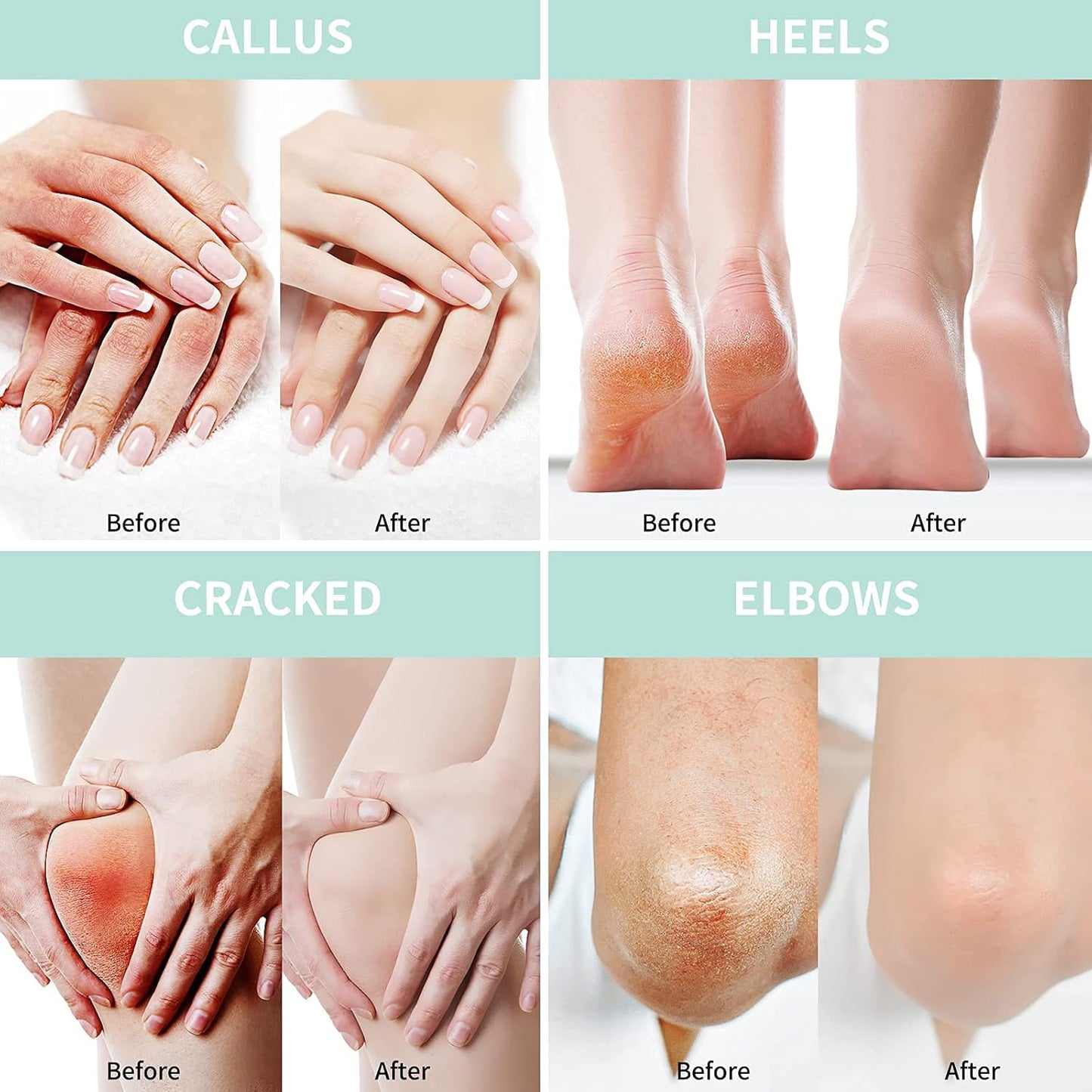 Urea Cream 40% with Salicylic Acid - Maximum Strength Foot Cream | 5.30 oz, Deep Moisturizing with Hyaluronic Acid & Aloe Vera
