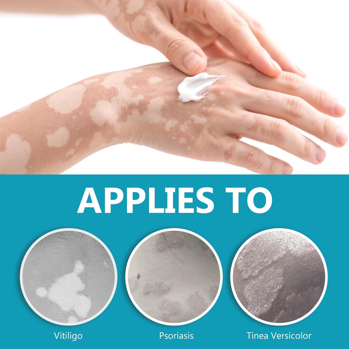 Vitiligo Cream| Effective Treatment of Skin Vitiligo, Reduce Uneven Skin Tone, White Spots, Promote Melanin Production of the Active Ingredients, Suitable for Both Men and Women, 20G