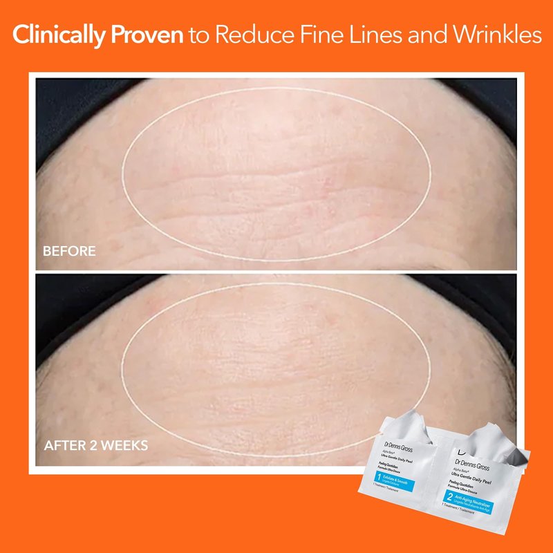 Dr. Dennis Gross Alpha Beta Ultra Gentle Daily Peel: for Dehydrated or Sensitive Skin, Uneven Tone or Texture, Fine Lines or Enlarged Pores (5 Treatments)