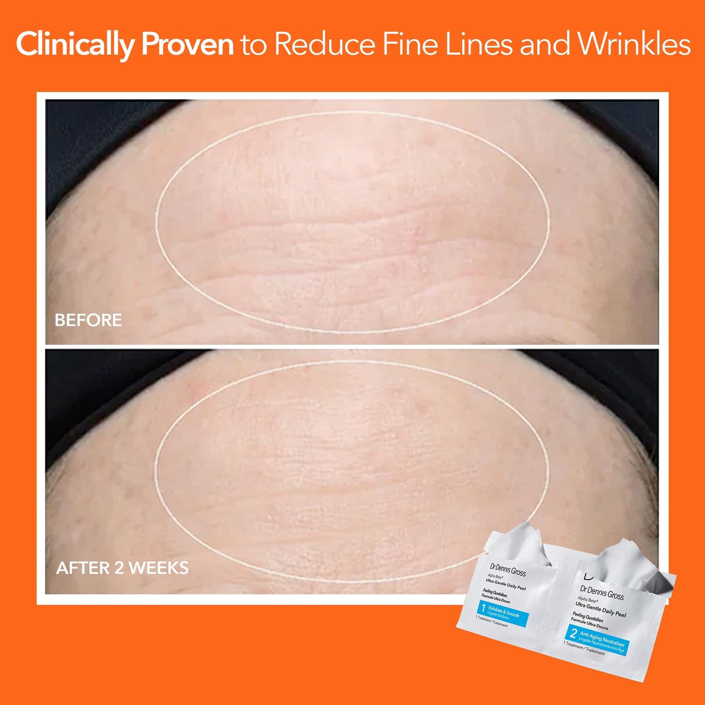 Dr. Dennis Gross Alpha Beta Ultra Gentle Daily Peel: for Dehydrated or Sensitive Skin, Uneven Tone or Texture, Fine Lines or Enlarged Pores (5 Treatments)