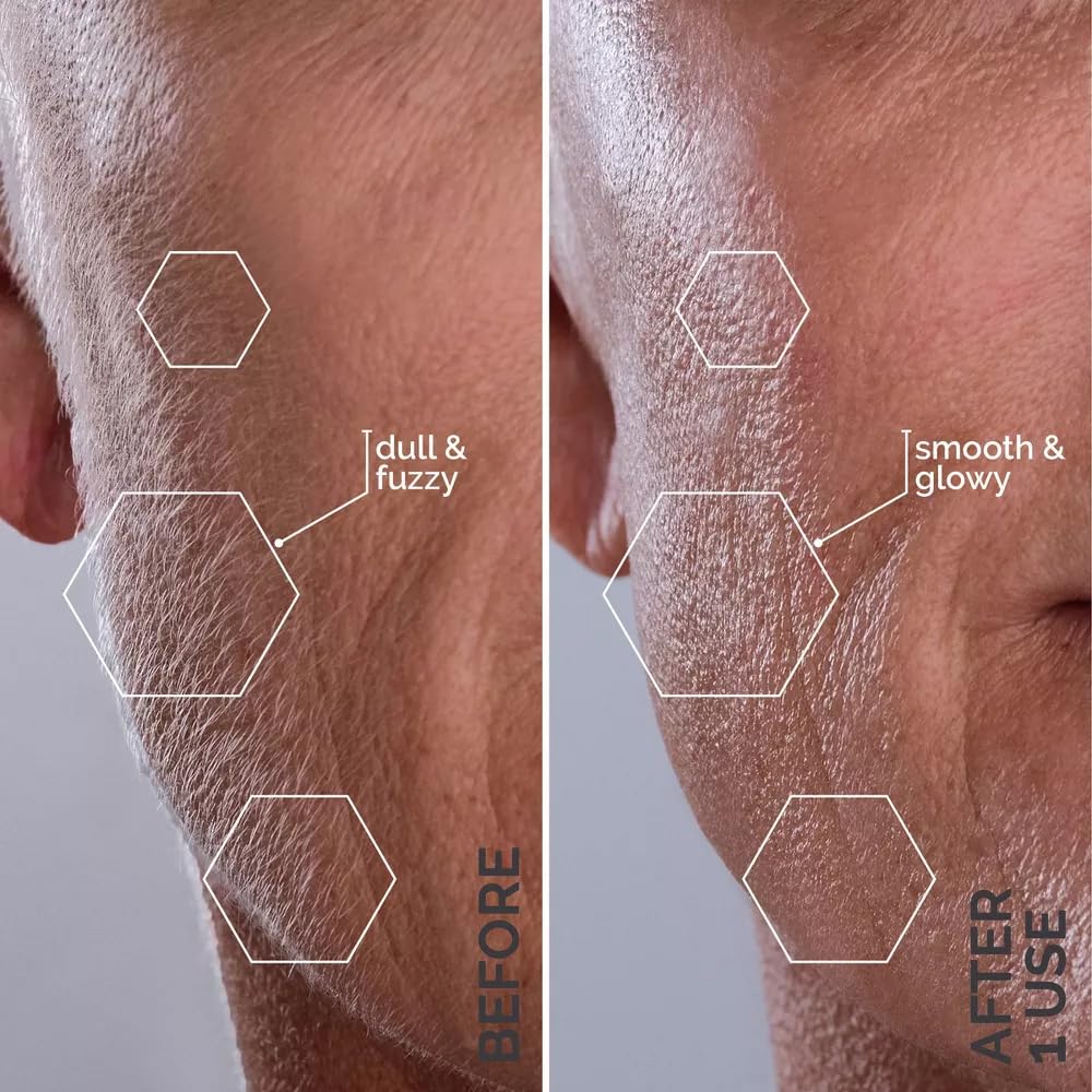 Spa Sciences SIMA DELUXE - Dermaplaning Tool for Painless Facial Exfoliation & Peach Fuzz Removal - 14 Weeks of Treatment Included
