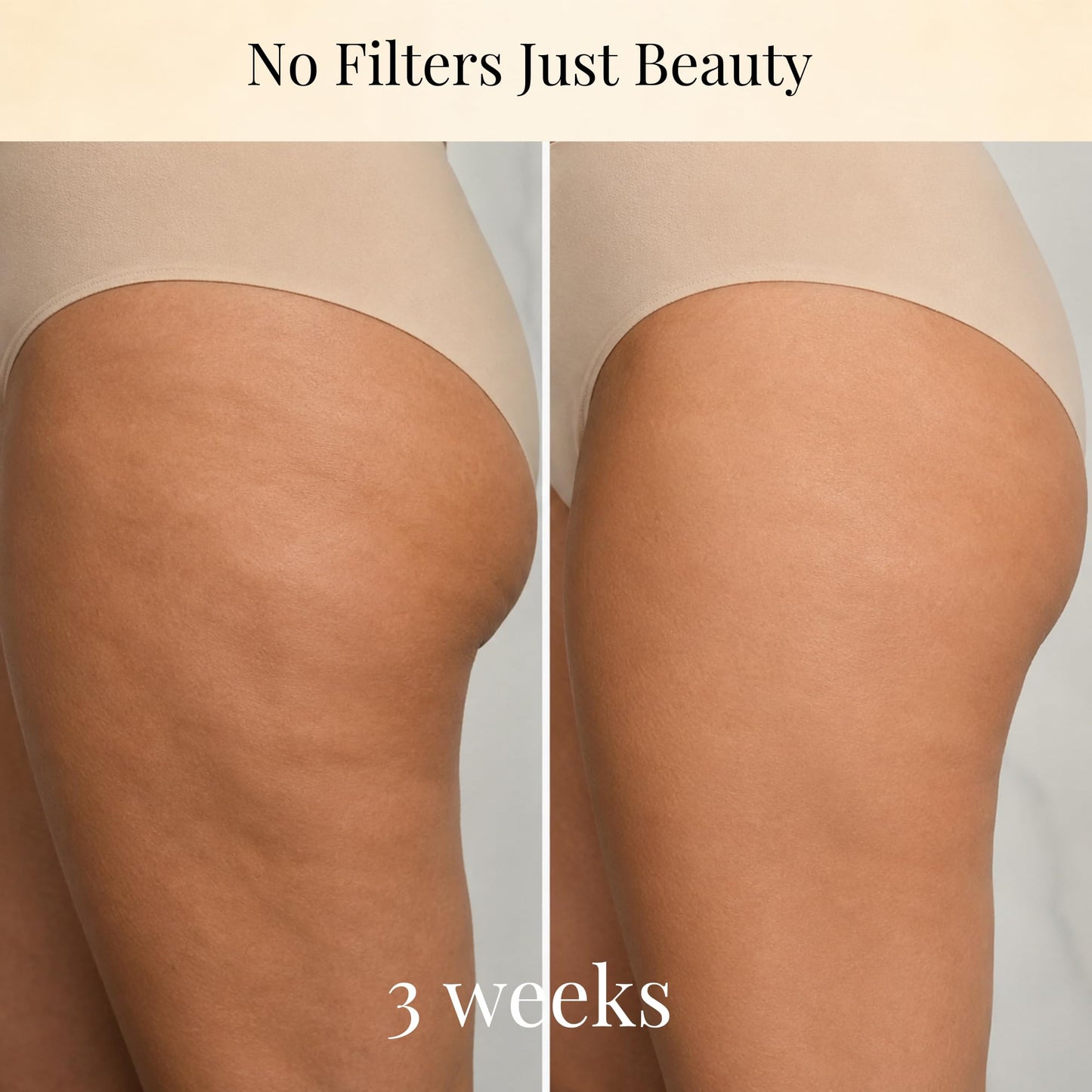 ANACIS Anti Cellulite Cream – Hot Body Firming Gel for Smoother Looking Skin, Improves Appearance of Uneven Texture & Elasticity, Warming Body Cream for Thighs & Stomach, 5.07 Oz