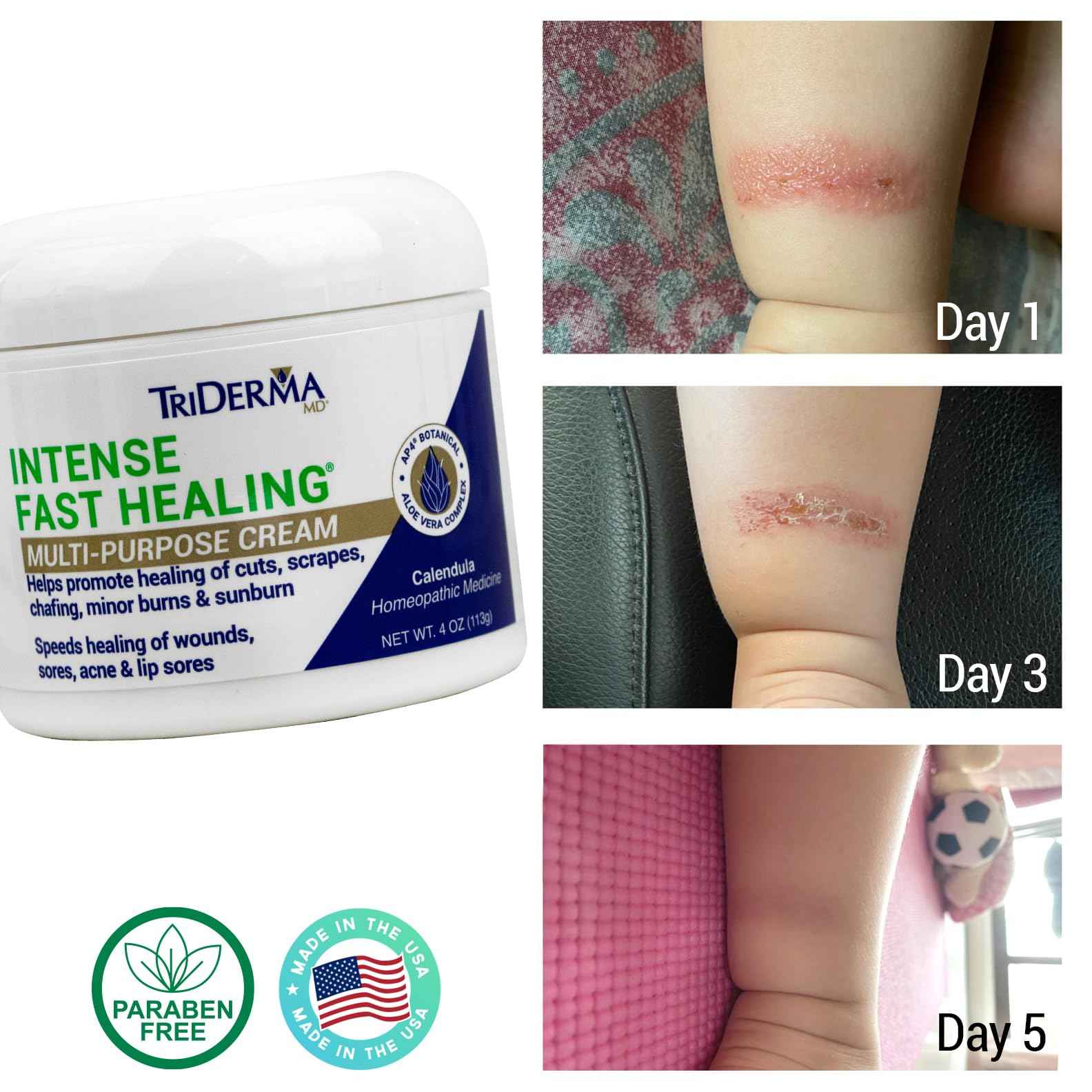 TriDerma Intense Fast Healing Cream, Decreases Healing Time for Minor Irritations, Rashes, Scrapes, Cuts 4 Ounces