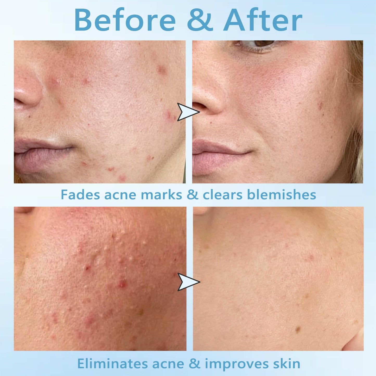 Salicylic Acid Drying Lotion – Fade Acnes Marks, Improve Skin Condition, Oil Control, Gentle Skincare for Sensitive Skin 10ml/0.35fl.Oz