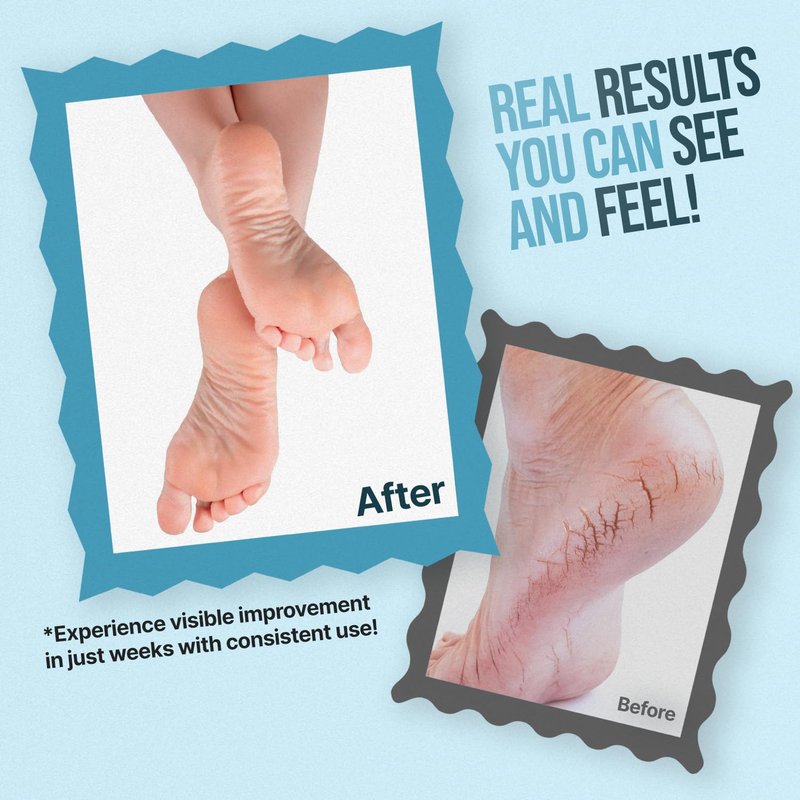 Free Life Labs - Urea Cream for Feet - Maximum Strength 42% Foot Cream for Calluses and Dry Feet - Free Pumice Stone and Brush - Shea and Mango Butters-Paraben Free-Fragrance Free- 4oz.
