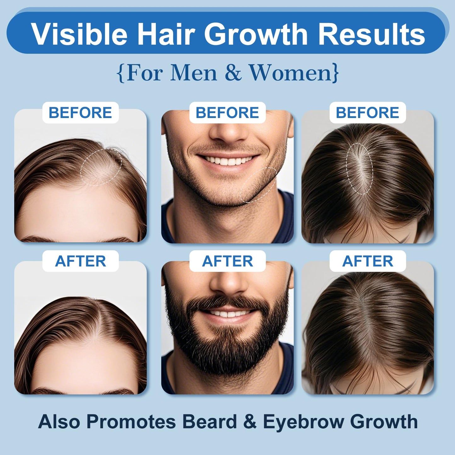 5% Minoxidil Foam with Biotin – Hair & Beard Growth Treatment for Men & Women, Fragrance-Free, Non-Greasy, 4-Month Supply (8.44oz), Clinically Trusted Formula ERYLVEKA