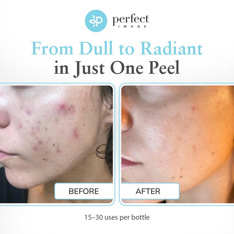 Glycolic Acid 30% Gel Peel - Enhanced with Retinol and Green Tea Extract (Professional Chemical Peel)- 1 fl oz 30mL