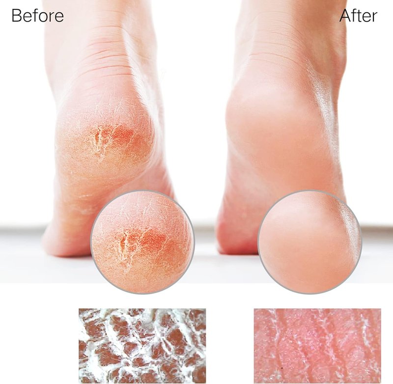 Sunivaca Glass Foot File Callus Remover for Feet, Heel Scraper, Pumice Stone, Diabetic Feet Scrubber Dead Skin Remover for Feet Professional Pedicure Tools