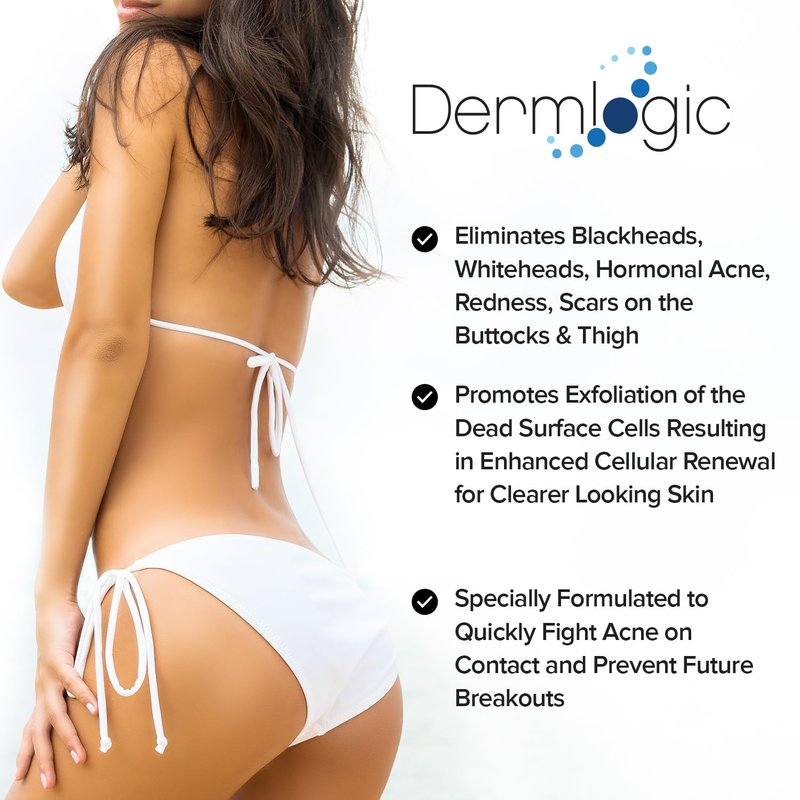 Butt & Thigh Acne Treatment - Fights Acne, Pimples, Zits, Blackheads and Ingrown Hairs for the Buttocks and Thigh Area. Fades Away Dark Spots, Acne marks. Prevents Future Breakouts. 6.09 oz