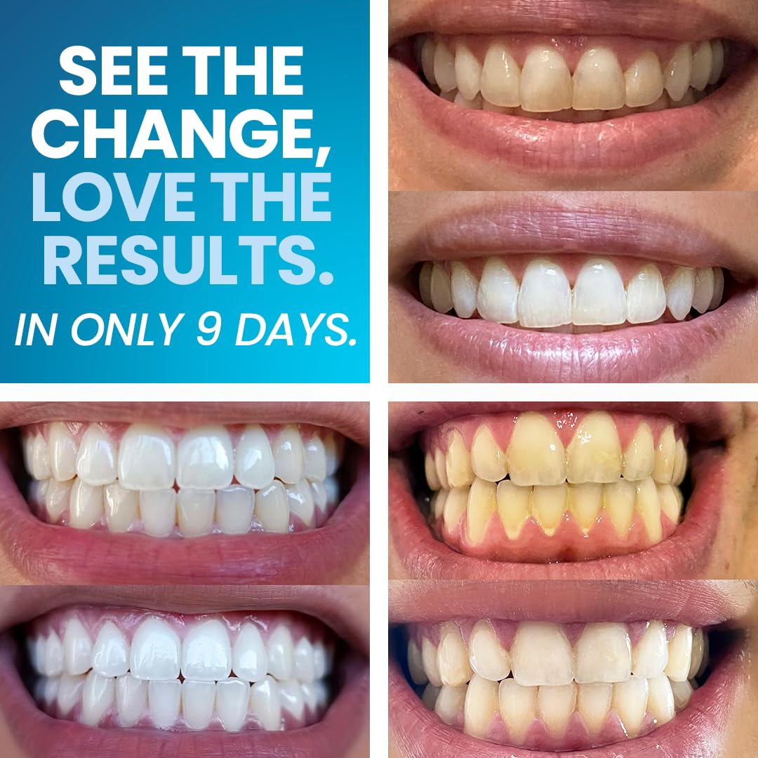EmeraWhite Teeth Whitening Kit - 9-Day Whitening System for Sensitive Teeth - Professional At-Home Treatment for Fast, Safe Results | Enamel Safe