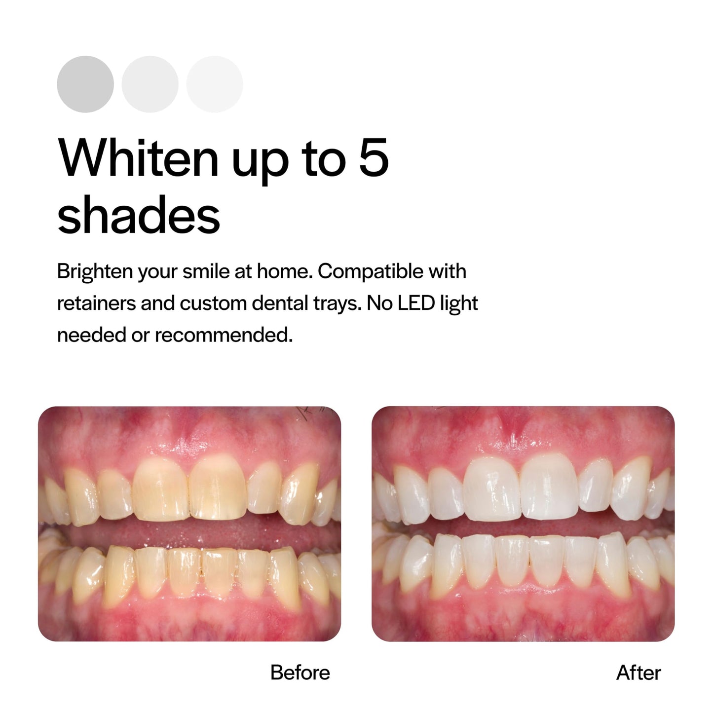 Opalescence 20% Teeth Whitening Refill Kit (4 Syringes) Carbamide Peroxide. Made by Ultradent, in Mint Flavor. Tooth Whitening Refill Syringes. Includes a Toothbrush. - 5196-2TB