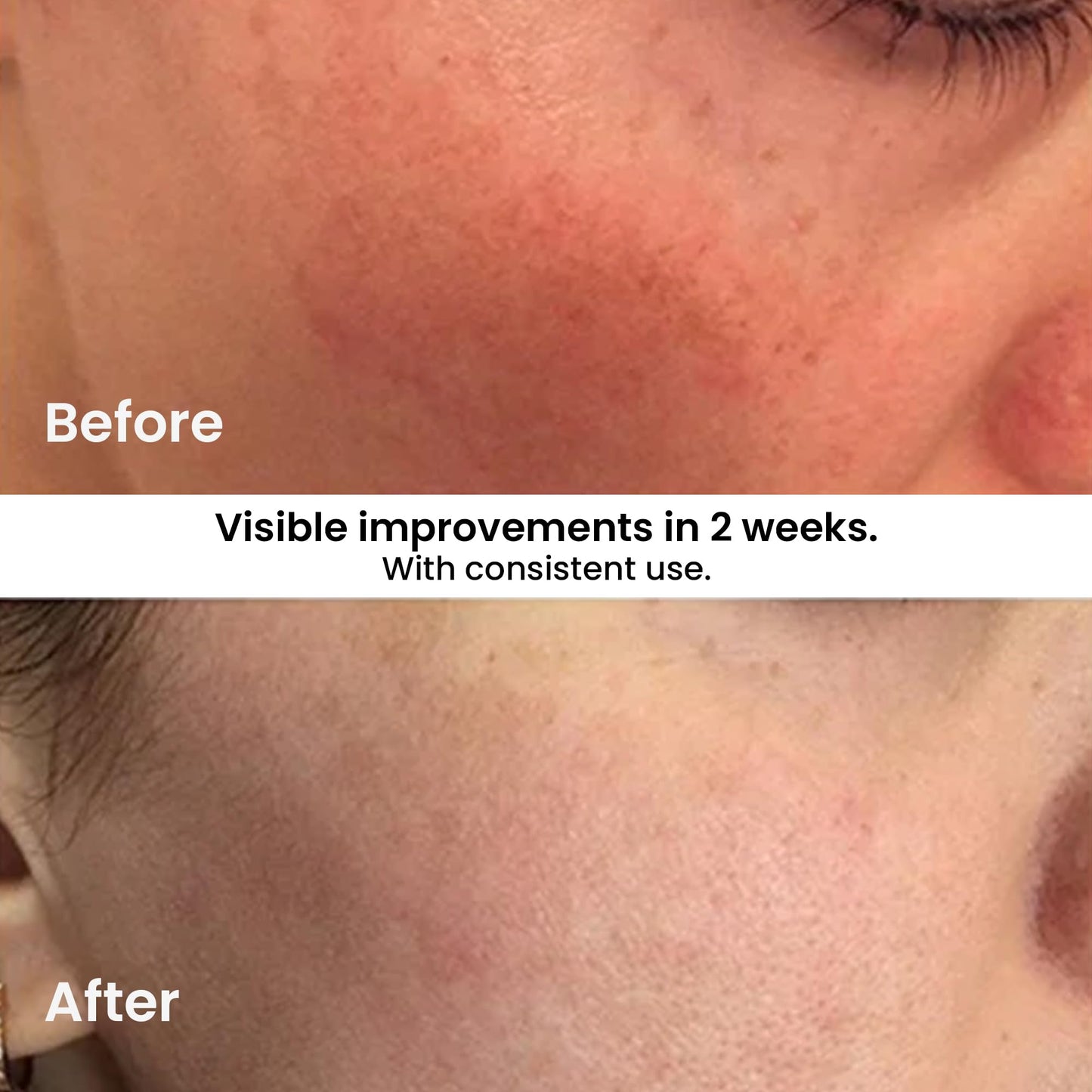 Kleem Anti Aging Vitamin C Serum for Face - Brightening Serum for Dark Spots, Age Spots, Wrinkles & Sun Damage - Face Serum with Hyaluronic Acid, Vitamin E & Aloe Vera - 1.7oz