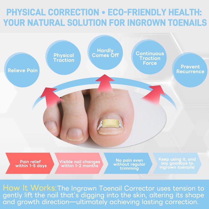 InhwRior Ingrown Toenail Corrector, Easy At-Home Application, Secure Fit (No Slipping Off), Steady Traction for Rapid Pain Relief, Waterproof for Shower & Swimming(0.83" to 0.91" Toenail Length)