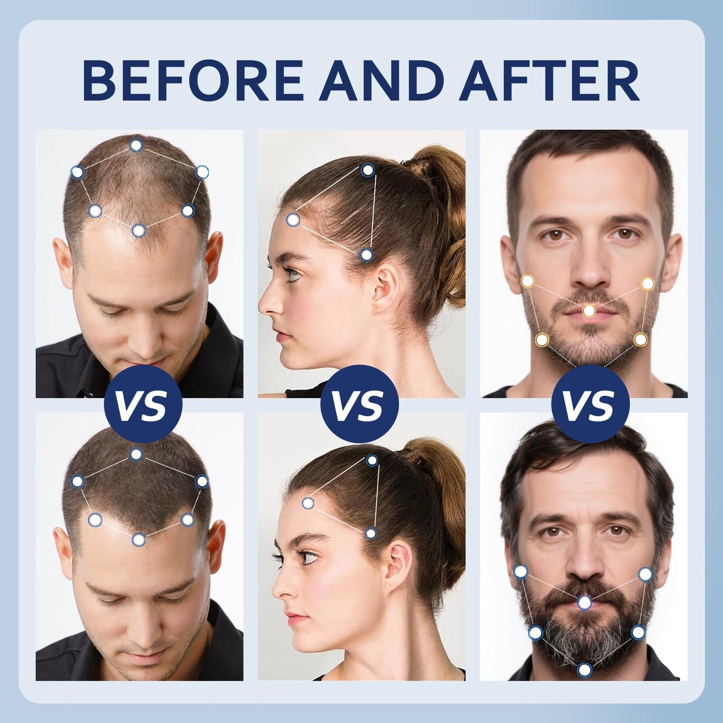 5% Minoxidil Hair Growth Serum for Men & Women with Biotin: Minoxidil for Men and Women, 5 Percent, Hair Regrowth Treatment, Extra Strength (4 FL OZ, Dropper 2pcs)