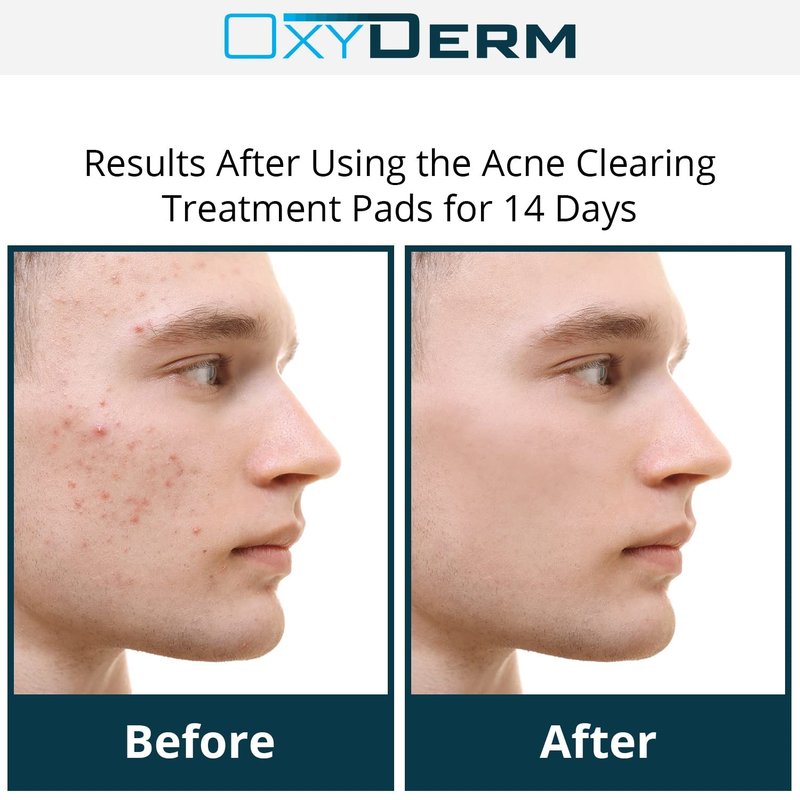 Acne Treatment Pads - Clear Clogged Pores & Fight Breakouts | 60 Count, Oily Skin Solution