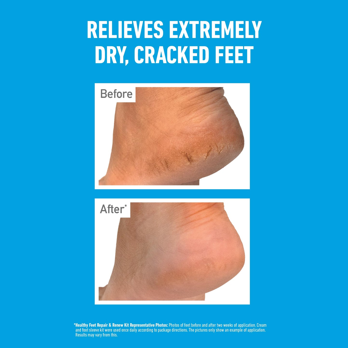 O'Keeffe's Healthy Feet Exfoliating 85g (5 Pack)