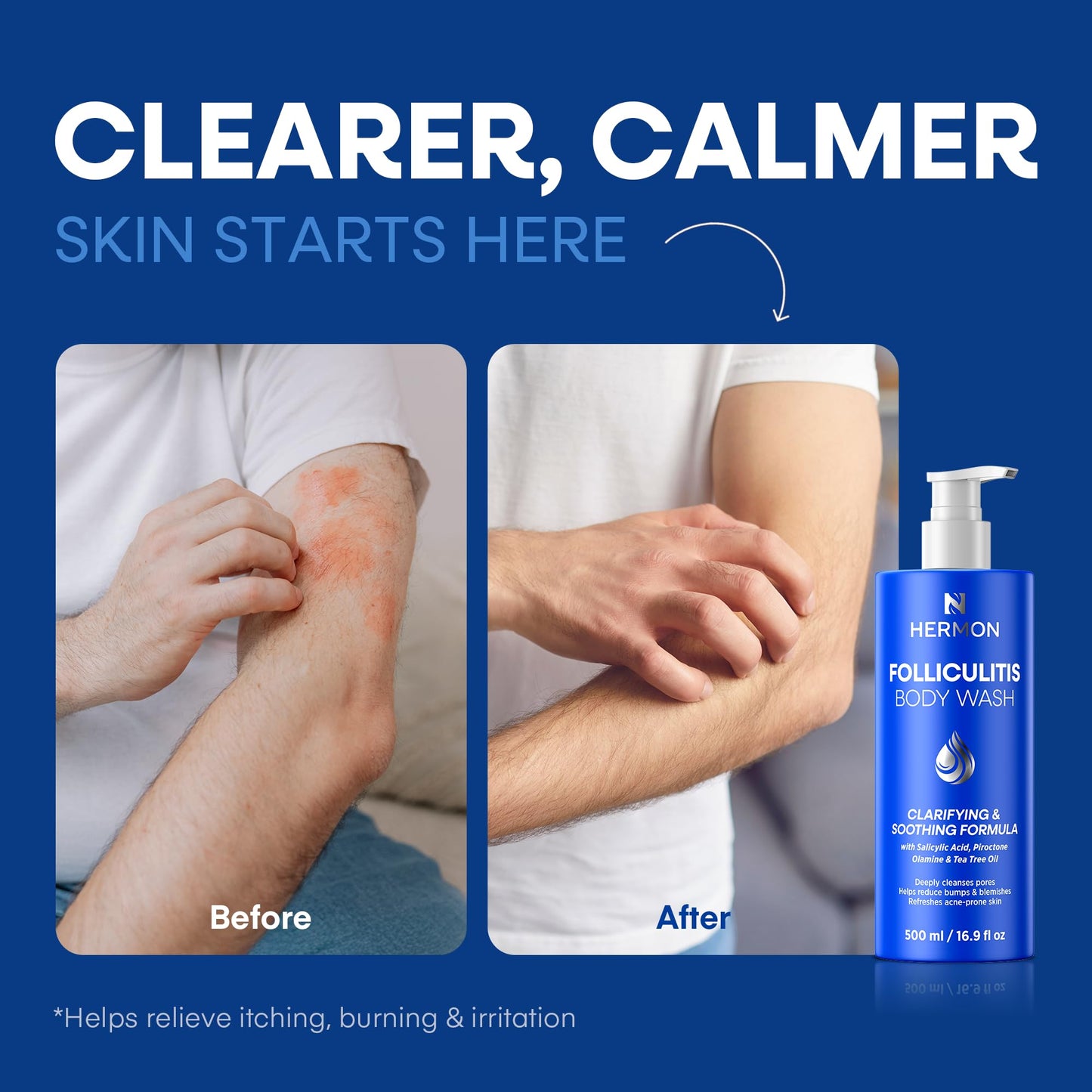 Hermon Folliculitis Body Wash with Tea Tree Oil