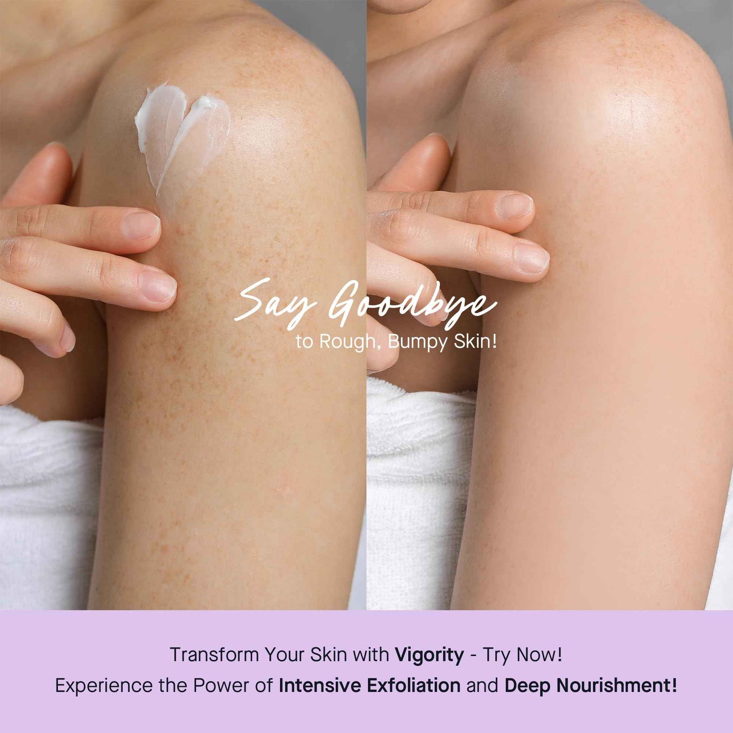 Vigority Keratosis Pilaris Treatment Cream with Lactic Acid – KP Body Bump Exfoliating Moisturizer for Rough, Bumpy, Dry & Flakey Skin, Strawberry Legs – 5.1 Oz