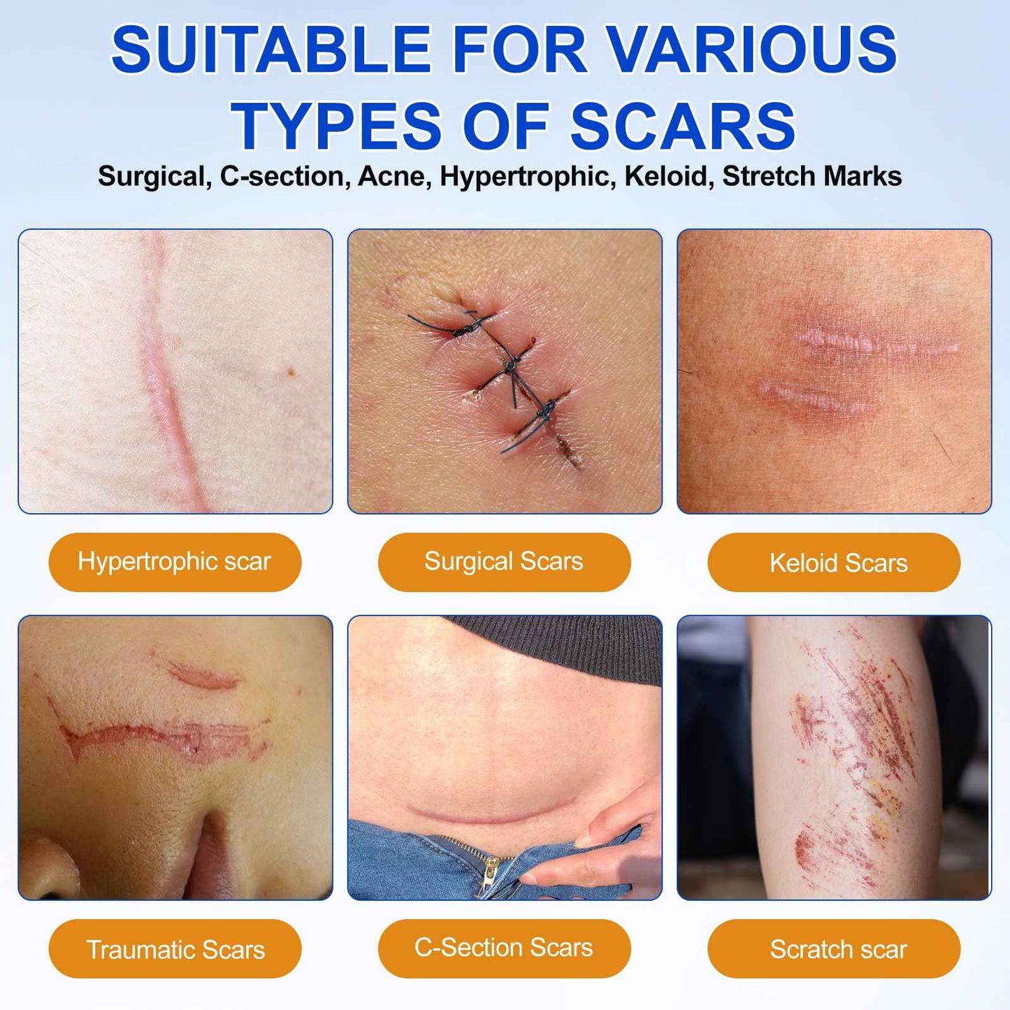 Silicone Scar Sheets, Silicone Scar Tape (1.6”x 120” Roll-3M), Medical Grade Scar Tape for Surgical Scars, Reusable Silicone Tape for Surgical, C-Section, Tummy Tuck, Keloid Scars