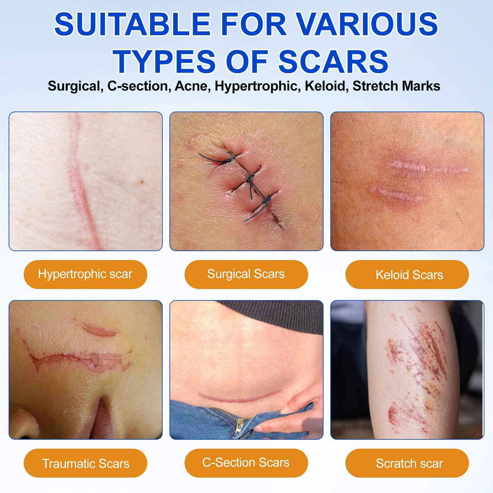 Silicone Scar Sheets, Silicone Scar Tape (1.6”x 120” Roll-3M), Medical Grade Scar Tape for Surgical Scars, Reusable Silicone Tape for Surgical, C-Section, Tummy Tuck, Keloid Scars